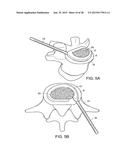 IN-SITU FORMED INTERVERTEBRAL FUSION DEVICE AND METHOD diagram and image