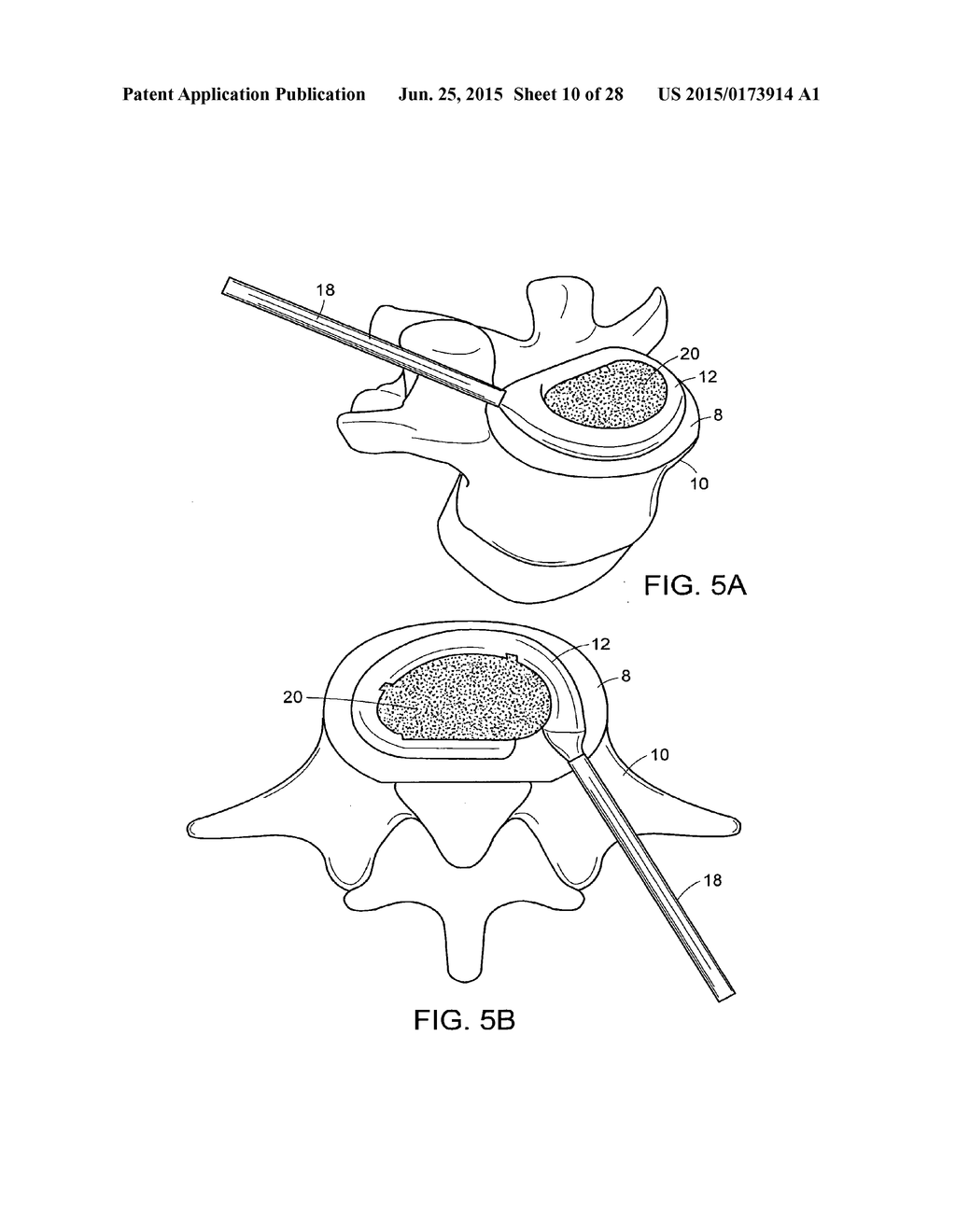 IN-SITU FORMED INTERVERTEBRAL FUSION DEVICE AND METHOD - diagram, schematic, and image 11