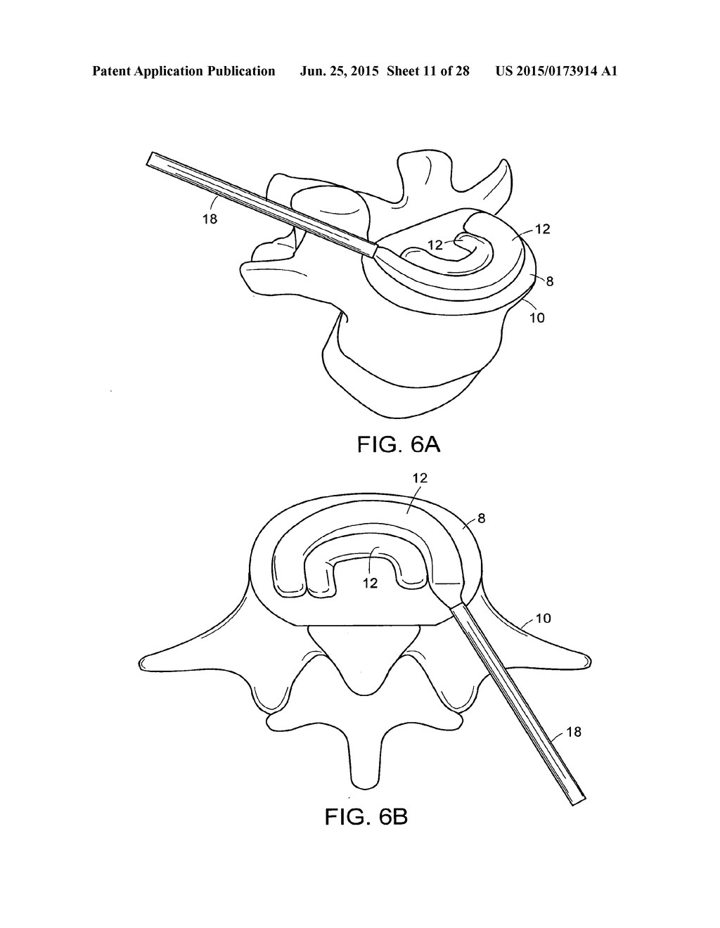 IN-SITU FORMED INTERVERTEBRAL FUSION DEVICE AND METHOD - diagram, schematic, and image 12