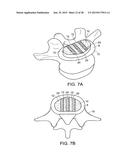 IN-SITU FORMED INTERVERTEBRAL FUSION DEVICE AND METHOD diagram and image