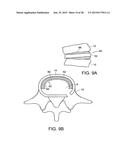 IN-SITU FORMED INTERVERTEBRAL FUSION DEVICE AND METHOD diagram and image