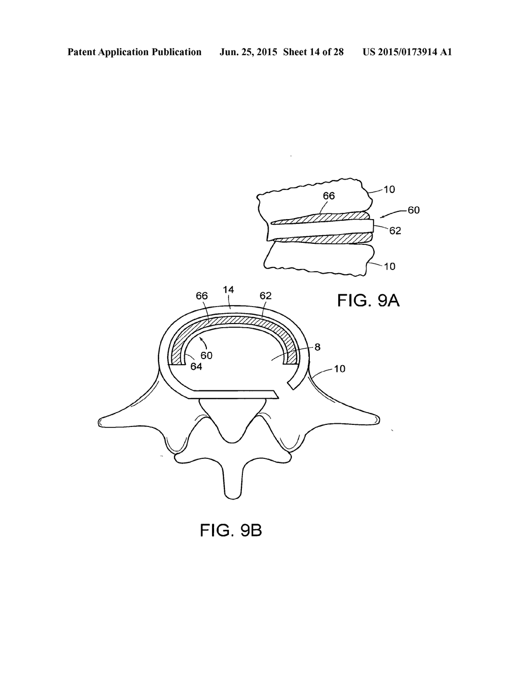 IN-SITU FORMED INTERVERTEBRAL FUSION DEVICE AND METHOD - diagram, schematic, and image 15