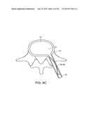 IN-SITU FORMED INTERVERTEBRAL FUSION DEVICE AND METHOD diagram and image