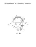 IN-SITU FORMED INTERVERTEBRAL FUSION DEVICE AND METHOD diagram and image