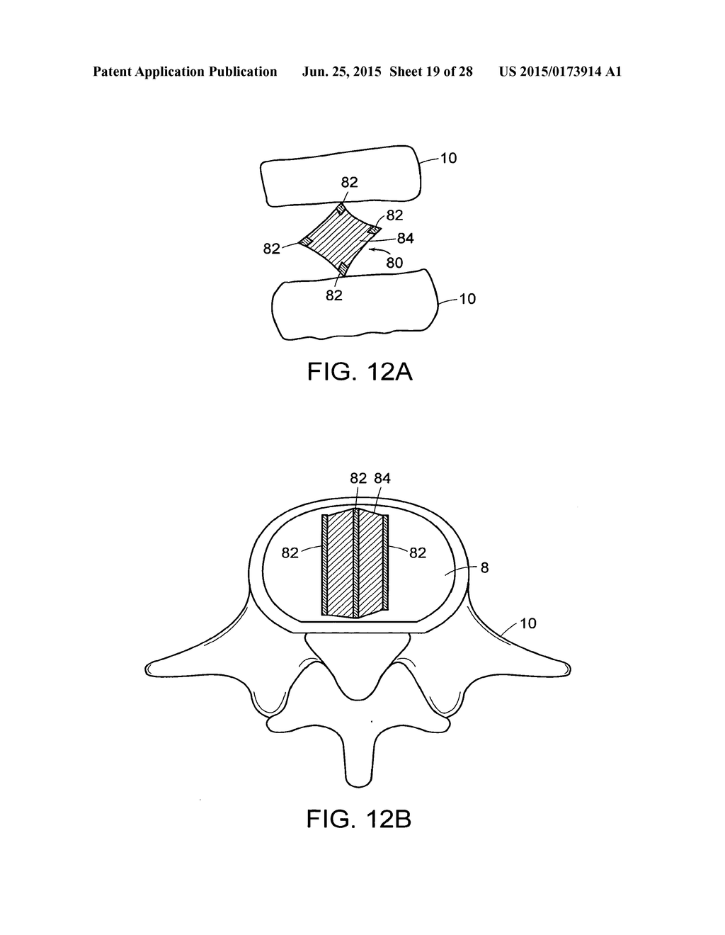 IN-SITU FORMED INTERVERTEBRAL FUSION DEVICE AND METHOD - diagram, schematic, and image 20