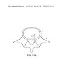 IN-SITU FORMED INTERVERTEBRAL FUSION DEVICE AND METHOD diagram and image