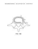 IN-SITU FORMED INTERVERTEBRAL FUSION DEVICE AND METHOD diagram and image