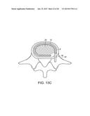 IN-SITU FORMED INTERVERTEBRAL FUSION DEVICE AND METHOD diagram and image