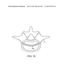 IN-SITU FORMED INTERVERTEBRAL FUSION DEVICE AND METHOD diagram and image