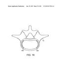 IN-SITU FORMED INTERVERTEBRAL FUSION DEVICE AND METHOD diagram and image