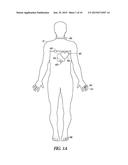 CARDIAC ASSIST DEVICE WITH PULSE WAVE ANALYSIS diagram and image