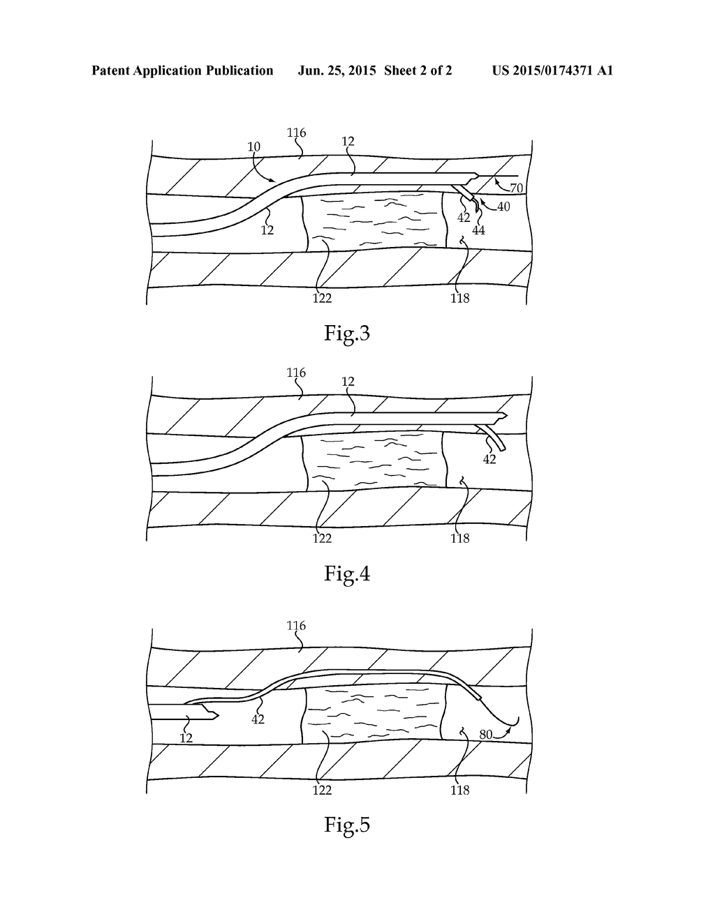 SYSTEM FOR BYPASSING VASCULAR OCCLUSION HAVING PUNCTURING MECHANISM AND     METHOD - diagram, schematic, and image 03