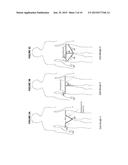 NON-INVASIVE PROSTATE COIL FOR MR SYSTEMS WITH VERTICAL MAIN FIELD diagram and image