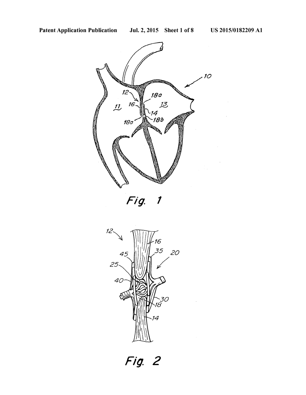 Septal Closure Device with Centering Mechanism - diagram, schematic, and image 02