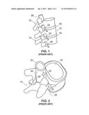 Devices and Methods for Temporarily Retaining Spinal Rootlets within Dural     Sac diagram and image