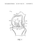 SYSTEMS AND METHODS FOR PREPARING A PROXIMAL TIBIA diagram and image