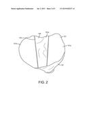 SYSTEMS AND METHODS FOR PREPARING A PROXIMAL TIBIA diagram and image