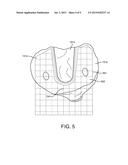 SYSTEMS AND METHODS FOR PREPARING A PROXIMAL TIBIA diagram and image