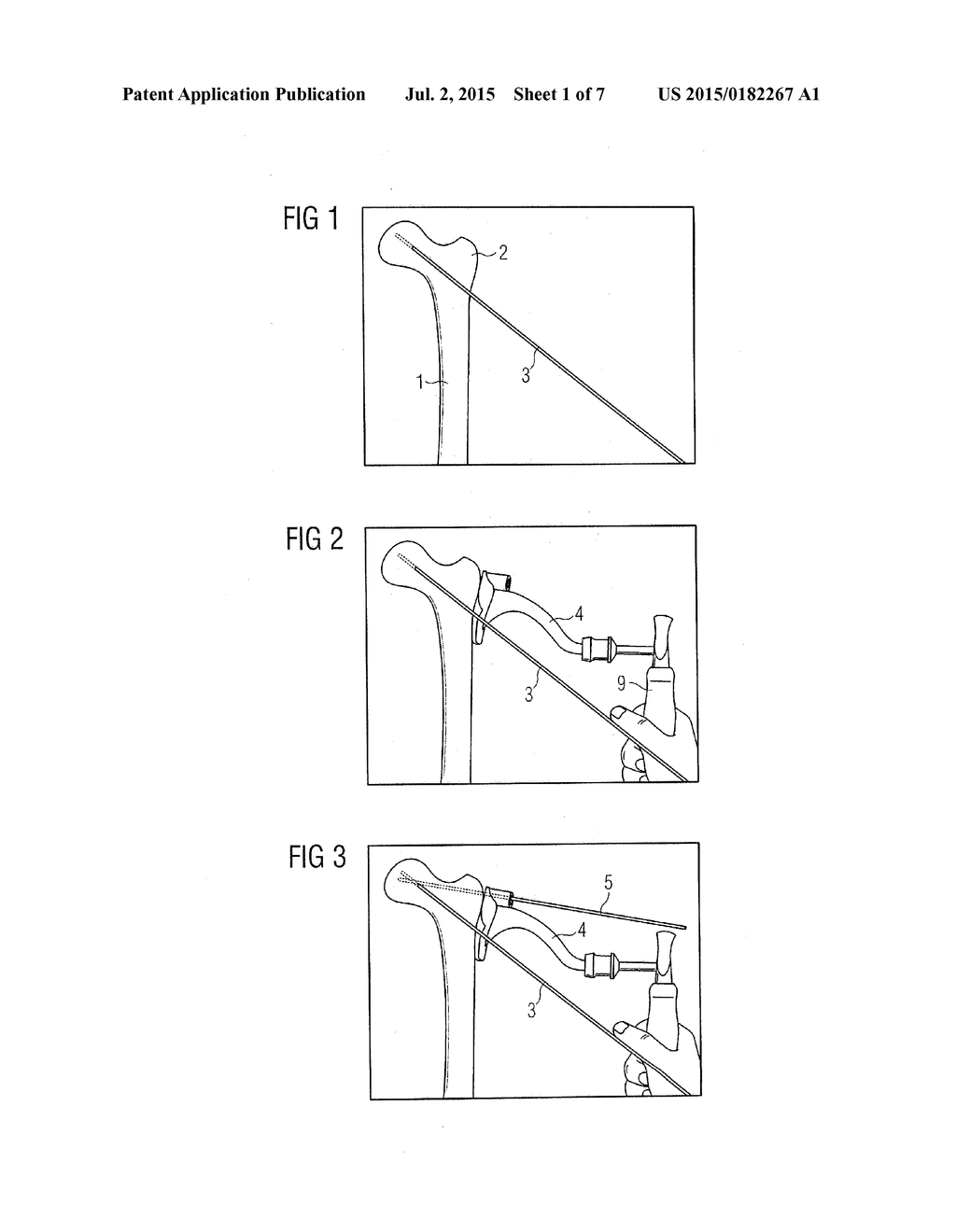 Method and Device for Attaching a Bone Plate - diagram, schematic, and image 02