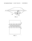 ABLATION TECHNIQUES FOR THE TREATMENT OF ATRIAL FIBRILLATION diagram and image