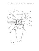 Customized Orthodontic Appliance and Method diagram and image