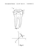 RESTORATION, RESTORATION COMPONENTS, AND METHODS OF MAKING A DENTAL     RESTORATION diagram and image