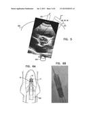 PROSTHETIC HEART VALVE HAVING IDENTIFIERS FOR AIDING IN RADIOGRAPHIC     POSITIONING diagram and image