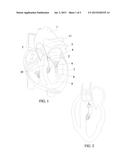 LEFT VENTRICULAR OUTFLOW DEVICE (LVODe) diagram and image