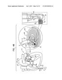 IMPLANTATION OF FLEXIBLE IMPLANT diagram and image