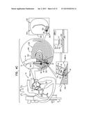 IMPLANTATION OF FLEXIBLE IMPLANT diagram and image