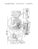 IMPLANTATION OF FLEXIBLE IMPLANT diagram and image