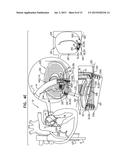 IMPLANTATION OF FLEXIBLE IMPLANT diagram and image