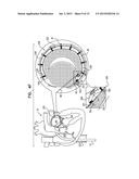 IMPLANTATION OF FLEXIBLE IMPLANT diagram and image