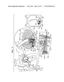 IMPLANTATION OF FLEXIBLE IMPLANT diagram and image