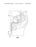 DRUG DELIVERY SYSTEMS AND METHODS FOR TREATMENT OF BLADDER DYSFUNCTION OR     DISORDER USING TROSPIUM diagram and image