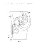 DRUG DELIVERY SYSTEMS AND METHODS FOR TREATMENT OF BLADDER DYSFUNCTION OR     DISORDER USING TROSPIUM diagram and image