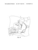 Self-Pressurizing Supraglottic Airway diagram and image