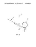 LEFT ATRIAL APPENDAGE TREATMENT SYSTEMS AND METHODS diagram and image