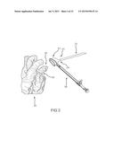 LEFT ATRIAL APPENDAGE TREATMENT SYSTEMS AND METHODS diagram and image