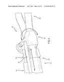 LEFT ATRIAL APPENDAGE TREATMENT SYSTEMS AND METHODS diagram and image