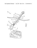 LEFT ATRIAL APPENDAGE TREATMENT SYSTEMS AND METHODS diagram and image