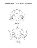 LEFT ATRIAL APPENDAGE TREATMENT SYSTEMS AND METHODS diagram and image