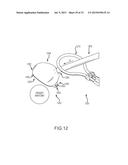 LEFT ATRIAL APPENDAGE TREATMENT SYSTEMS AND METHODS diagram and image