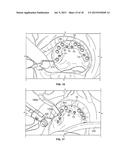 COMPONENTS FOR USE WITH A SURGICAL GUIDE FOR DENTAL IMPLANT PLACEMENT diagram and image