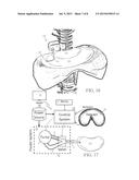 DIAPHRAGM ASSIST DEVICE diagram and image