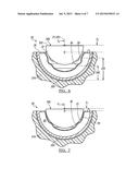 Deformable Prosthesis diagram and image