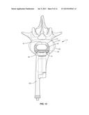 SPINAL IMPLANT SYSTEM AND METHOD diagram and image