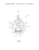 SPINAL IMPLANT SYSTEM AND METHOD diagram and image