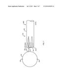 TRANSPYLORIC ANCHORING diagram and image