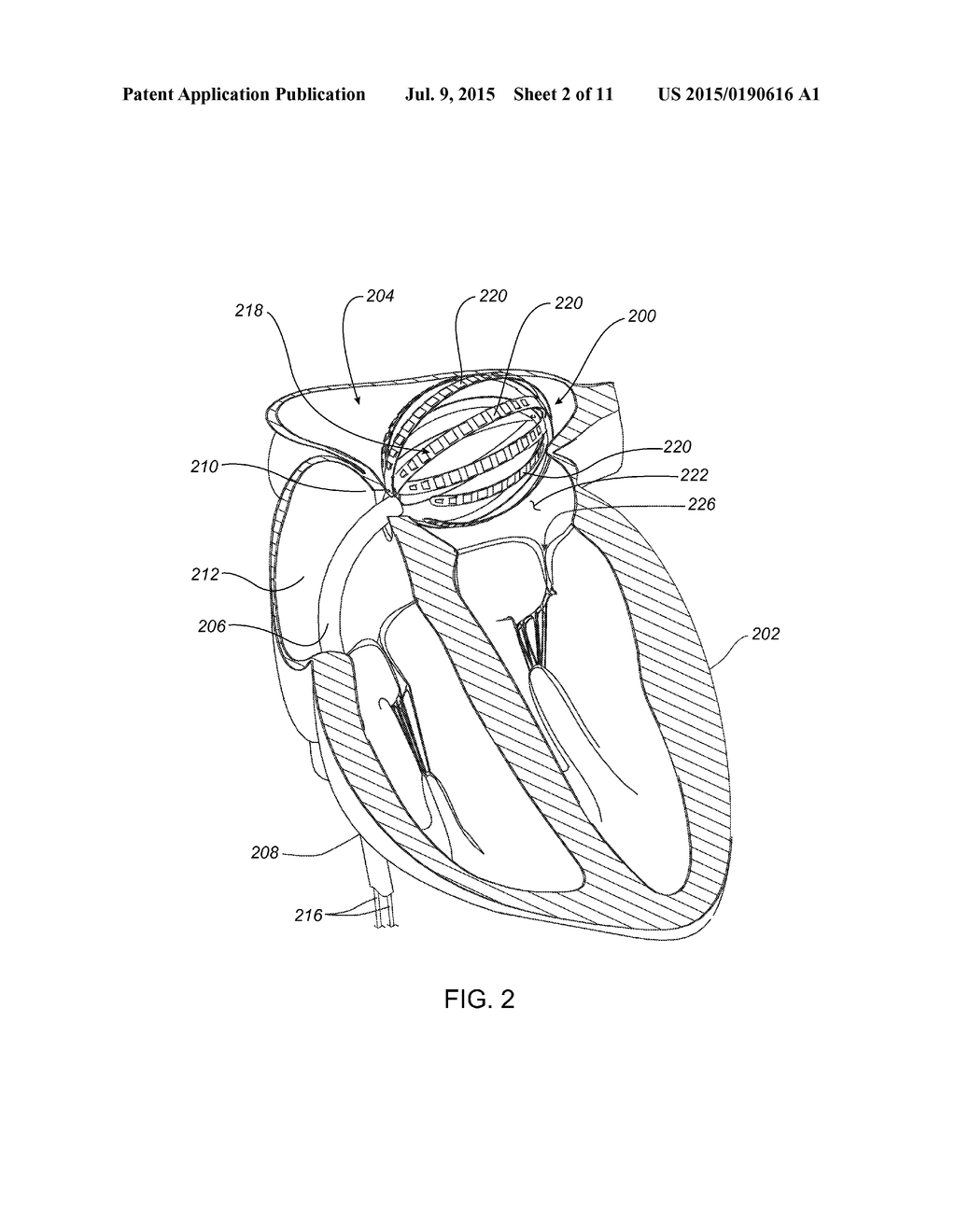 MEDICAL DEVICE INCLUDING MANIPULABLE PORTION WITH CONNECTED ELONGATE     MEMBERS - diagram, schematic, and image 03